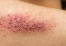 Krätze in KiTa Alzey